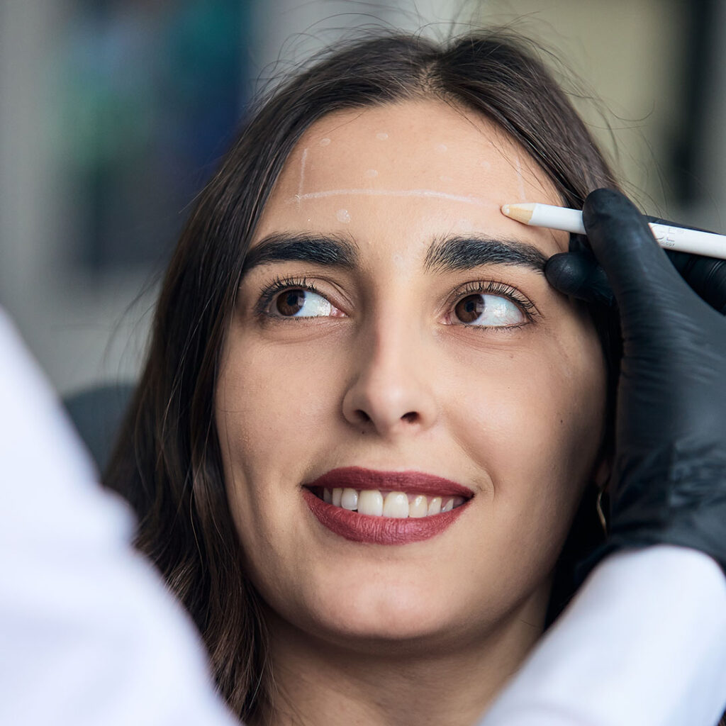 Zone aplikacije botoxa